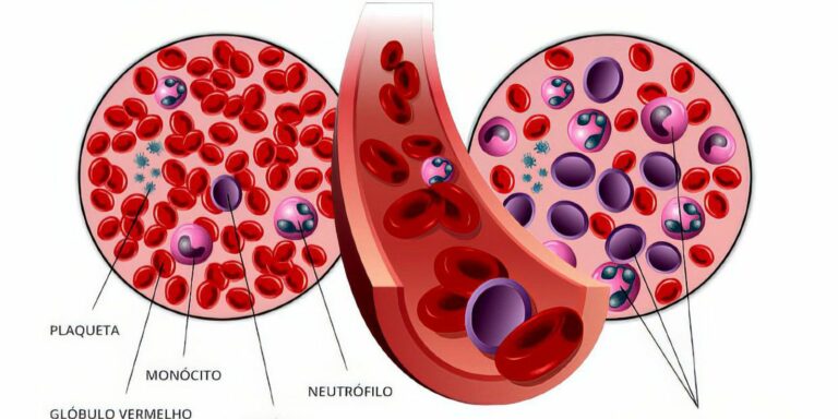 Anvisa autoriza pesquisa em pacientes com leucemia linfoide aguda B Anvisa autoriza pesquisa em pacientes com leucemia linfoide aguda B